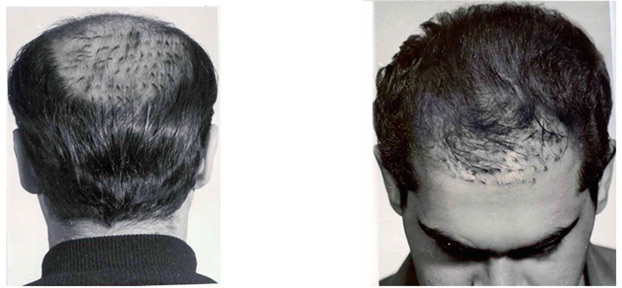 مقدمه ای بر کاشت مو :: مرکز کاشت موی دکتر توکلی