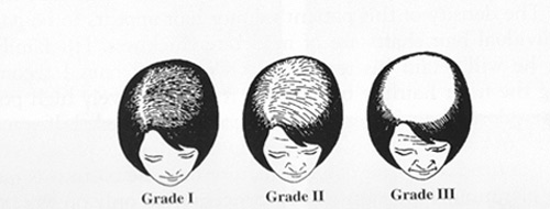 چرا موهای جلوی سر دچار ریزش می شوند ولی موهای ناحیه پشت سر در مقابل ریزش مقاوم تر می باشند؟‌