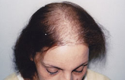 کاشت مو در خانم ها:: مرکز کاشت موی دکتر توکلی