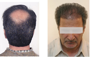 آمار کاشت مو:: مرکز کاشت موی دکتر توکلی